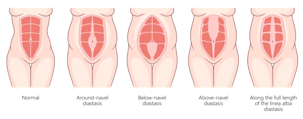 Understanding and Fixing Abdominal Separation
